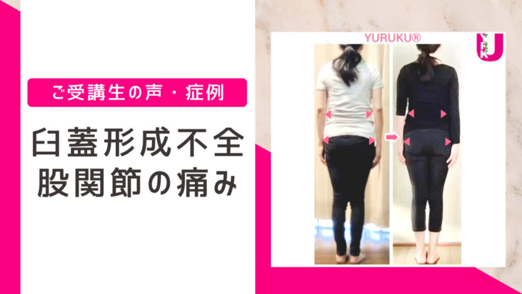 臼蓋形成不全・股関節の痛みが無くなり手術回避