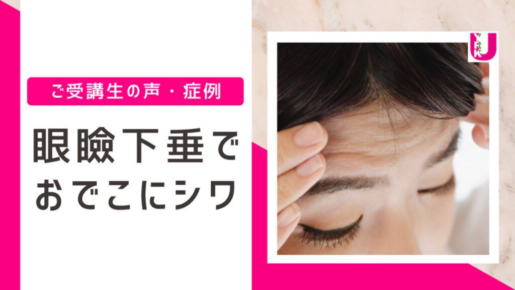 眼瞼下垂。おでこにシワを寄せなくても目が開けられるように