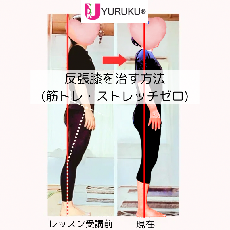 反張膝と反り腰が改善した40代女性の変化