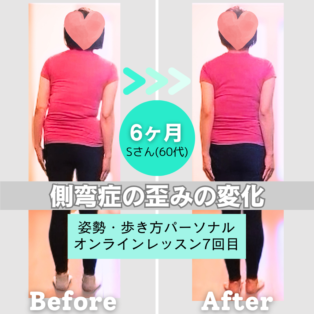 側弯症 術後 コルセット 医療用 男女兼用 姿勢矯正姿勢改善 Amazon | 脊柱側弯症の姿勢矯正器バックブレース脊椎コルセットベルト