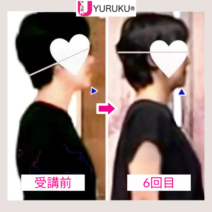 反対咬合による受け口が整い、頭部のねじれが解消して小顔に変化した横顔の比較写真。