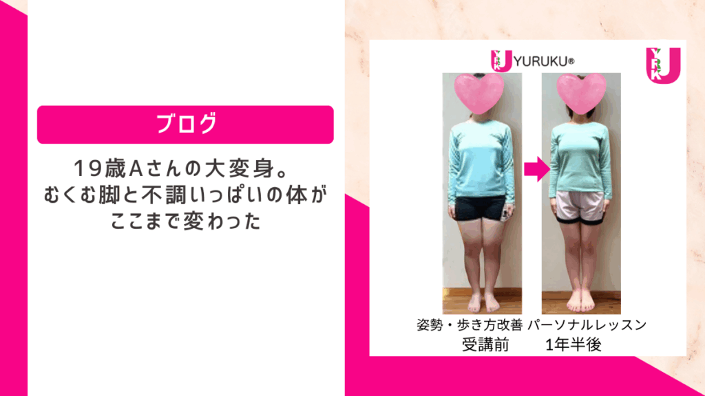 19歳女性Aさんの正面ビフォーアフター写真。むくみや不調が改善し、姿勢と脚のラインが整った変化。