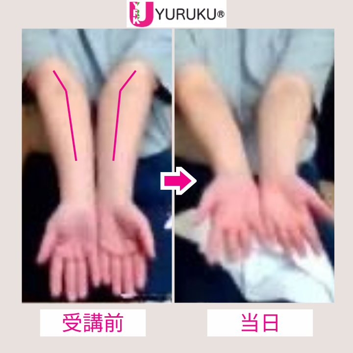 猿腕の肘の過伸展と、盛り上がっていた母指球が整った腕の比較写真。