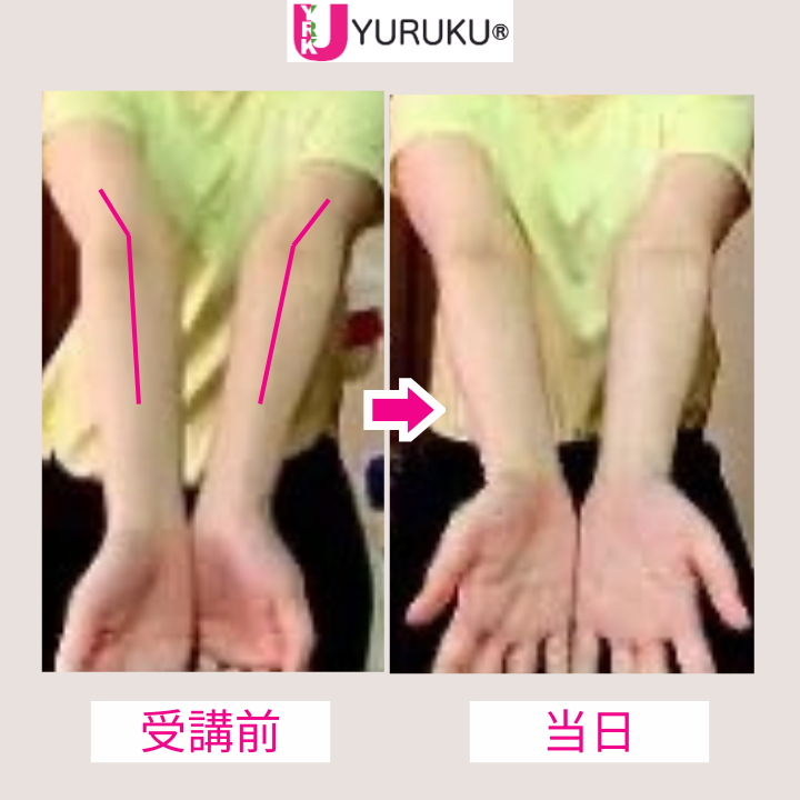 肘の過伸展と母指球の盛り上がりが解消され、腕の軸がまっすぐになった症例写真。