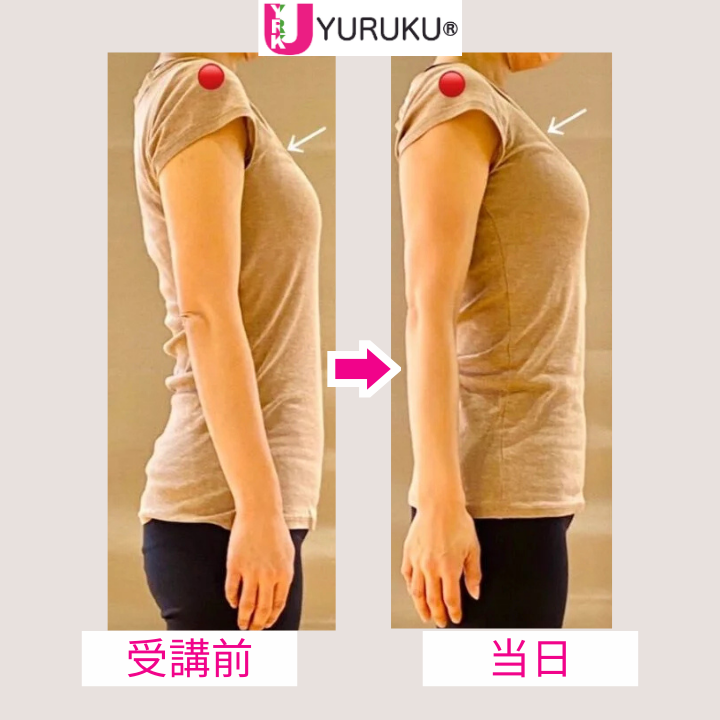 巻き肩が開き、肩から腕のラインがまっすぐに整った横向きの比較写真。