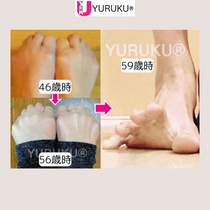 足指の把握力が高まり、しっかりと握れるようになった足指グーの比較写真。