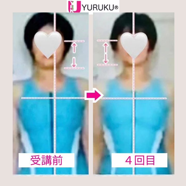 左右に傾いていた頭の位置が中央に戻り、フェイスラインが整った正面の比較写真。