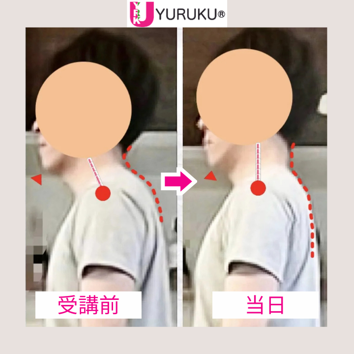 前方に突き出ていた頭の位置が後方へ戻り、ストレートネックが改善した横顔の比較写真。