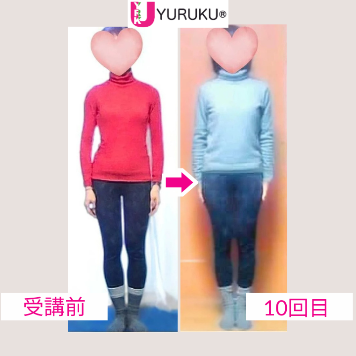 側弯症による背骨の大きな湾曲が、10回のレッスンでまっすぐに近づいた正面全身写真。