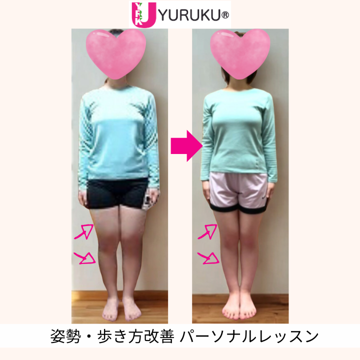 脚のねじれによるX脚が整い、太ももとふくらはぎが引き締まった正面全身写真（顔出しなし）