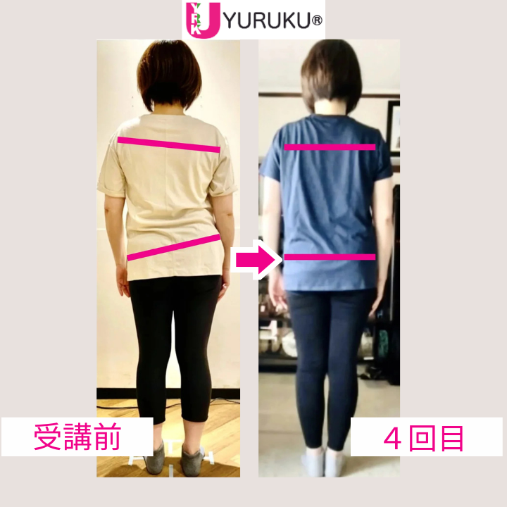 側弯症による背骨の曲がりが、4回のレッスン後に改善傾向を示した後ろ向き全身写真。