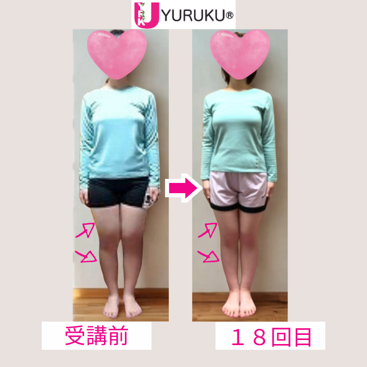 X脚と扁平足が改善し、太ももとふくらはぎが細くまっすぐになった全身の比較写真。