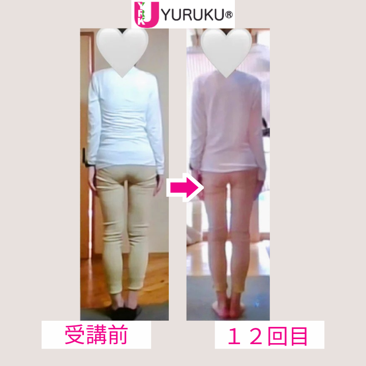 左右差のあった脚の長さが整い、下半身がまっすぐに変化した後ろ向きの全身比較写真。