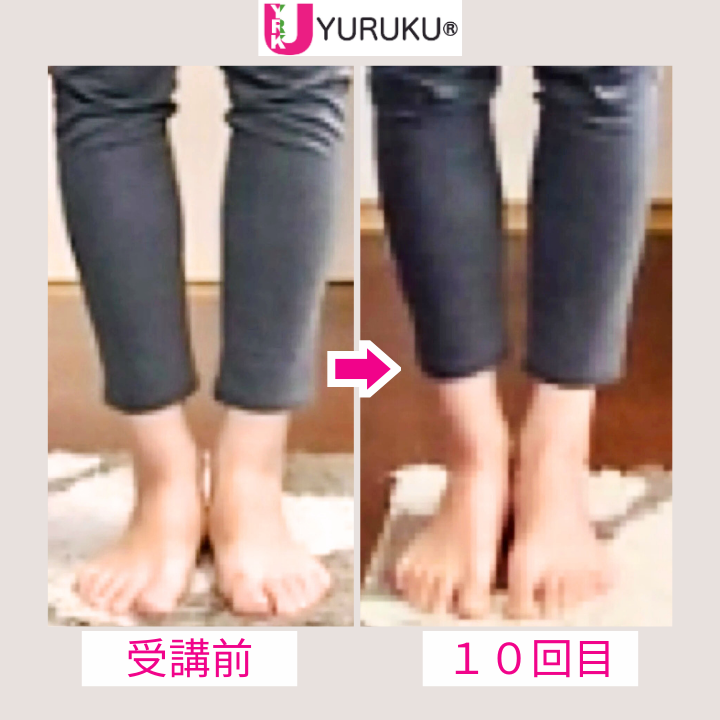 舟状骨の強い出っ張りと扁平足が、立ち方の改善により整った膝下の比較写真。