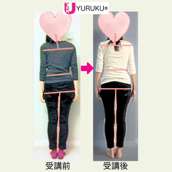 側弯症：後ろ姿のビフォーアフター比較写真