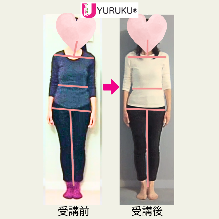 側弯症：正面の姿勢を比較したBefore／After写真