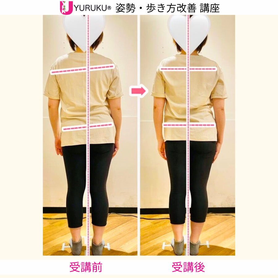 側弯症の姿勢変化が分かるよう体のラインに印を入れた比較画像