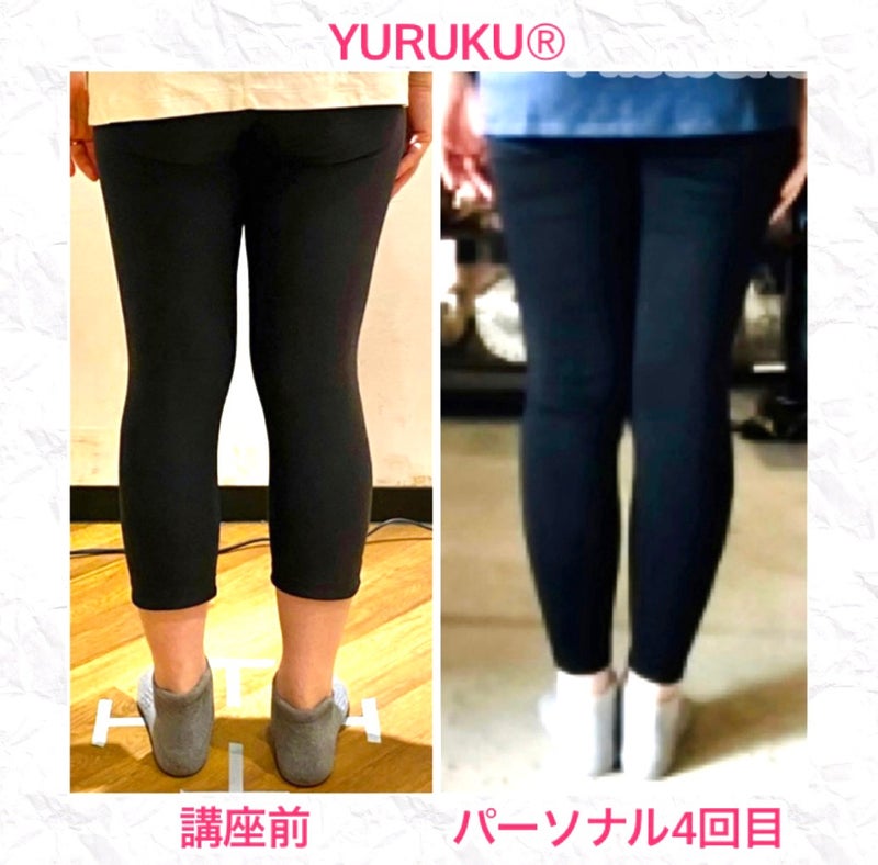 側弯症の生徒さんの脚の変化を示す、受講前とパーソナルレッスン4回目の足下の比較写真