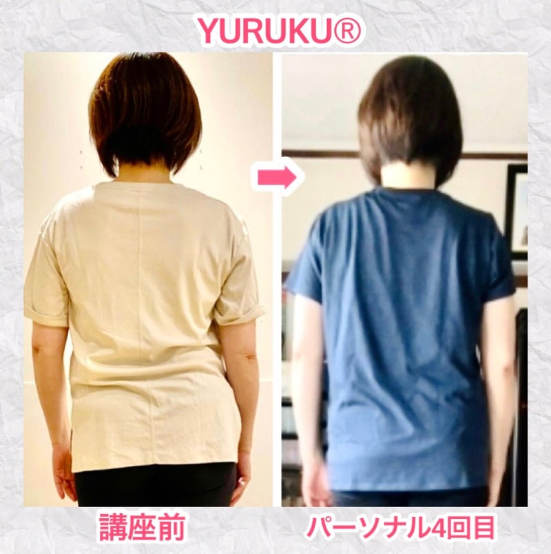 側弯症によって生じていた上半身の傾きと腕の位置が変化した様子を示す比較写真