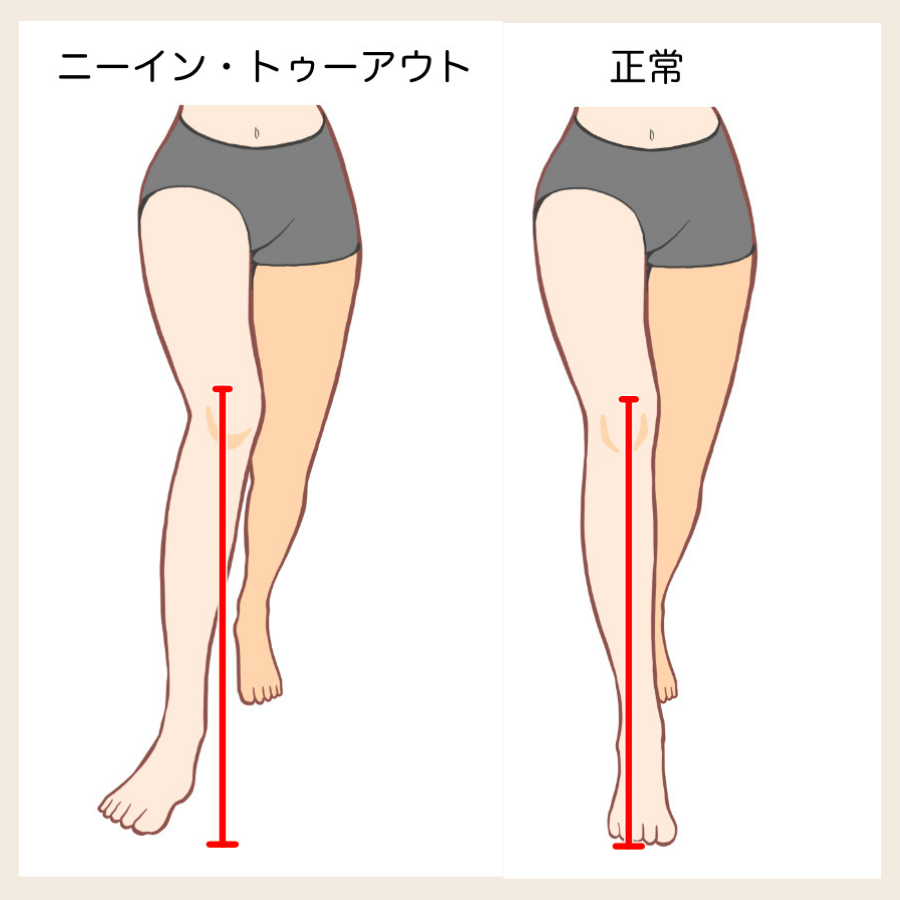 ニーイントゥアウトと正常歩行の比較|ねじれ歩行の例