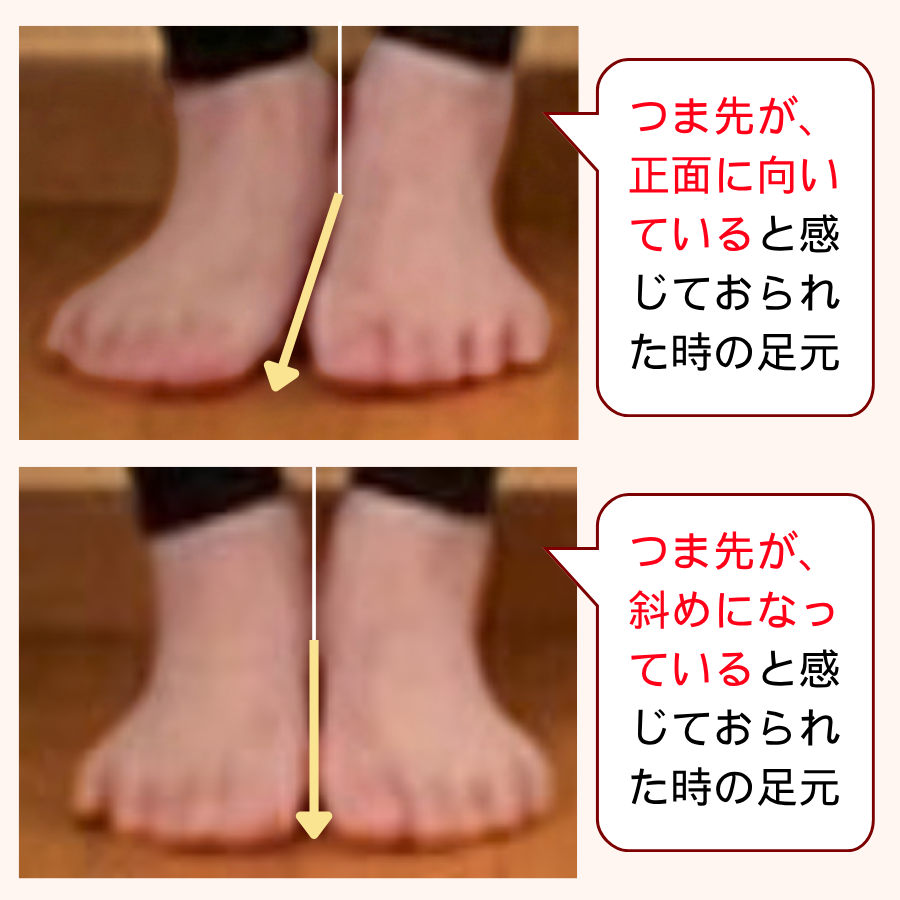 Eさんのつま先の比較。左は本人には真っ直ぐに見えていた実際には斜めの状態、右は真っ直ぐに整えた後の足元